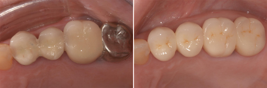 50歲的王女士是某所高中校長，她的後牙過去做了金屬假牙還有金屬瓷牙，某一天，其中一顆假牙裂掉了，讓她每次在咀嚼用餐的時候變得十分不好咬，而且食物殘渣常常塞在牙縫裡，增加清潔上的不便，於是前往日光翡麗新竹牙醫求診，才發現假牙牙齦萎縮。醫師建議牙齦萎縮治療方法採用全瓷冠假牙，不但堅硬又耐磨，在外觀上根本分辨不出真假！於是她…