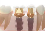 dental-implant