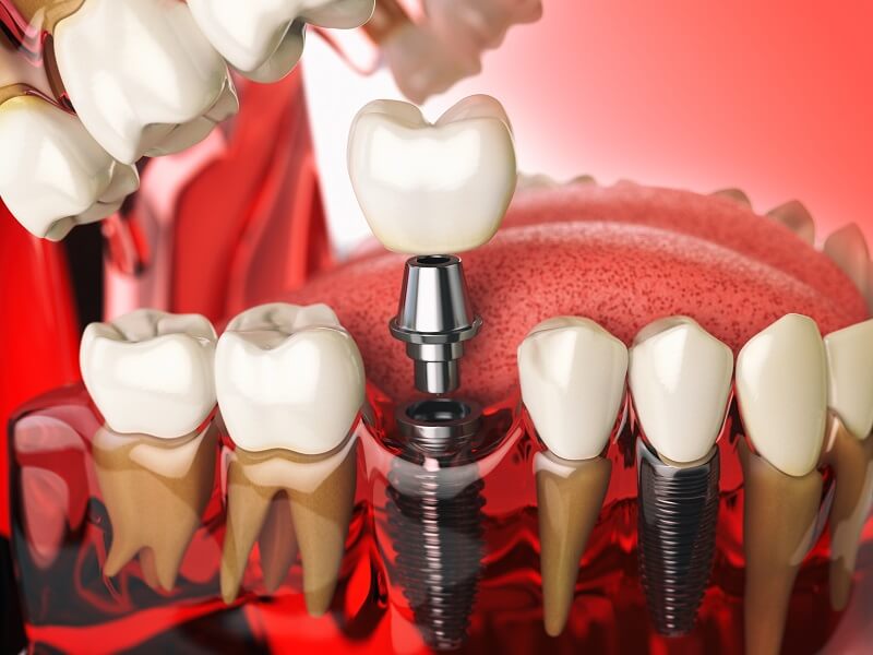 tooth-implant-molar