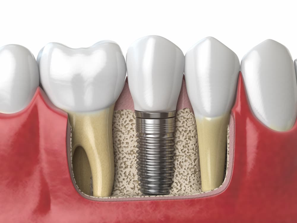 anatomy of healthy teeth and tooth dental implant 2021 08 26 16 56 57 utc 1 1